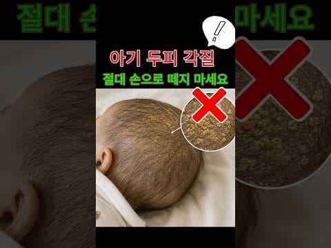 육아용품 유아 샴푸로 아기 지루성 두피염 신생아 두피 관리